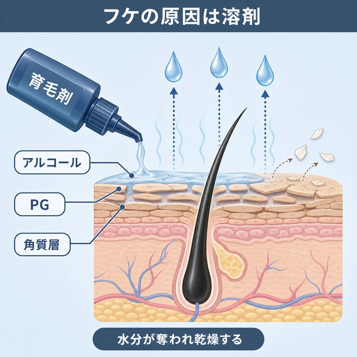 育毛剤の溶剤が頭皮の水分を奪い乾燥フケが生じる仕組みを表した頭皮断面の医療イラスト
