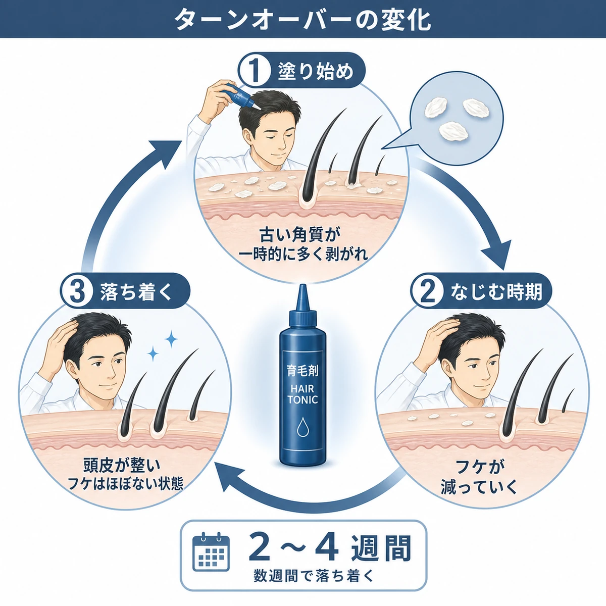 育毛剤の使い始めにターンオーバーが変化しフケが一時的に増えて数週間で落ち着く周期を表した医療イラスト