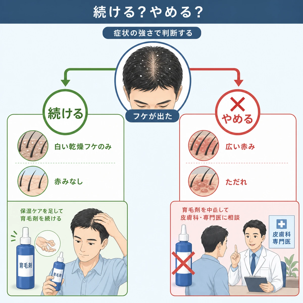 軽い乾燥フケは育毛剤を続け強い赤みやただれは中止する判断の分かれ道を表した医療イラスト