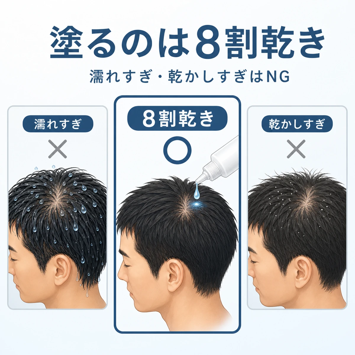 濡れすぎ・8割乾き・乾かしすぎの頭皮を比べて育毛剤に最適なタイミングを表した医療イラスト