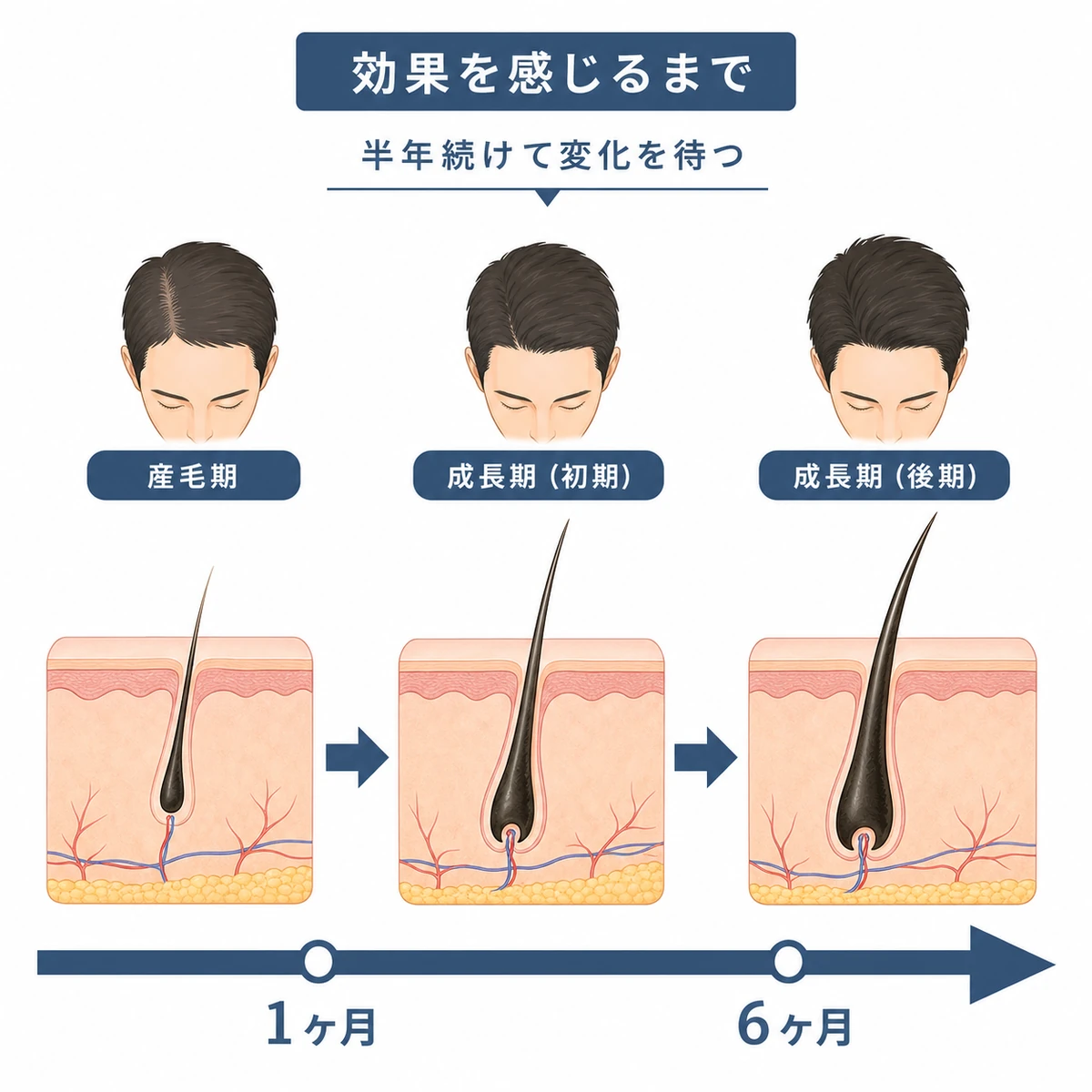 育毛剤の効果が半年かけて現れるヘアサイクルの流れを表した医療イラスト
