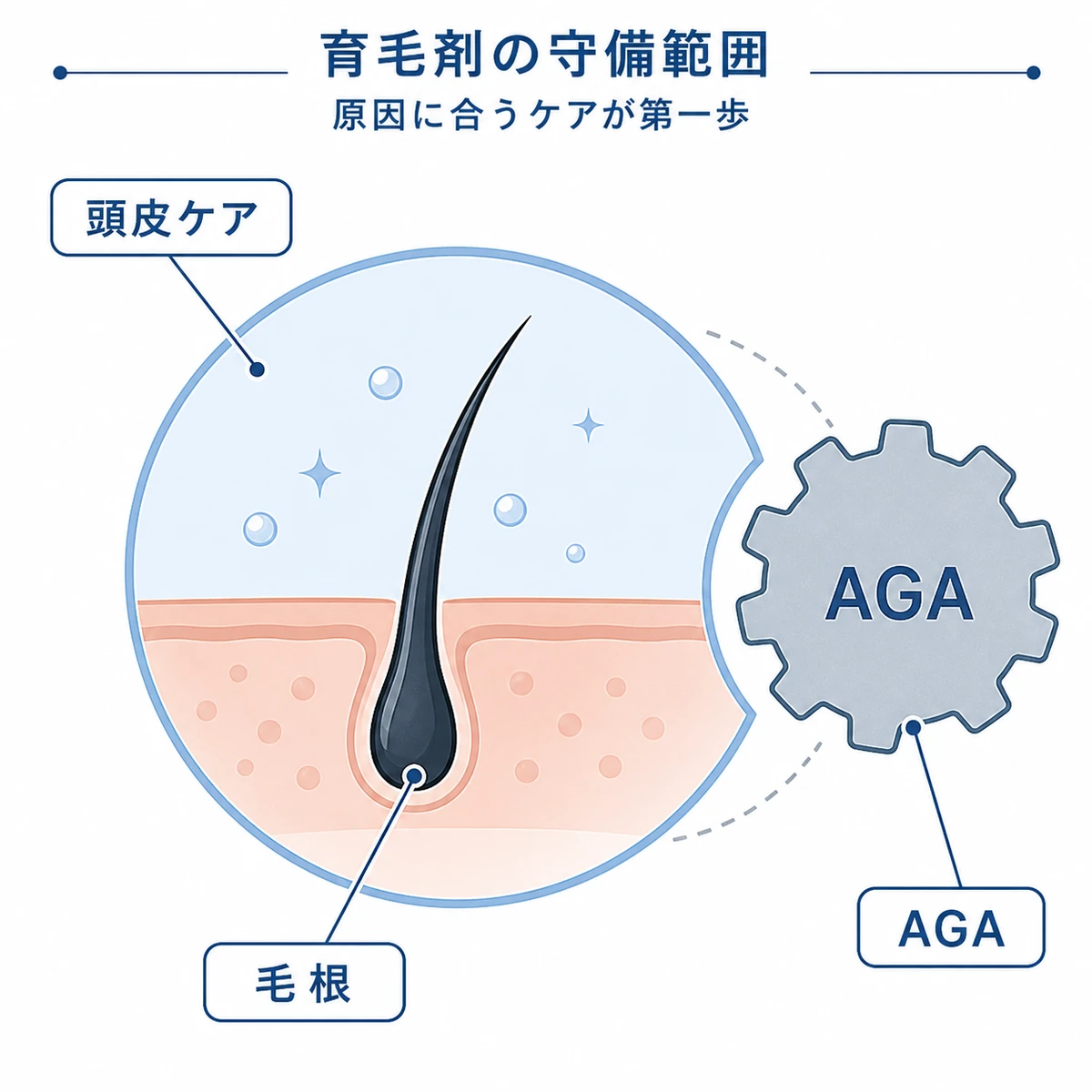 育毛剤が得意とする頭皮ケアの範囲とAGAの違いを表した医療イラスト