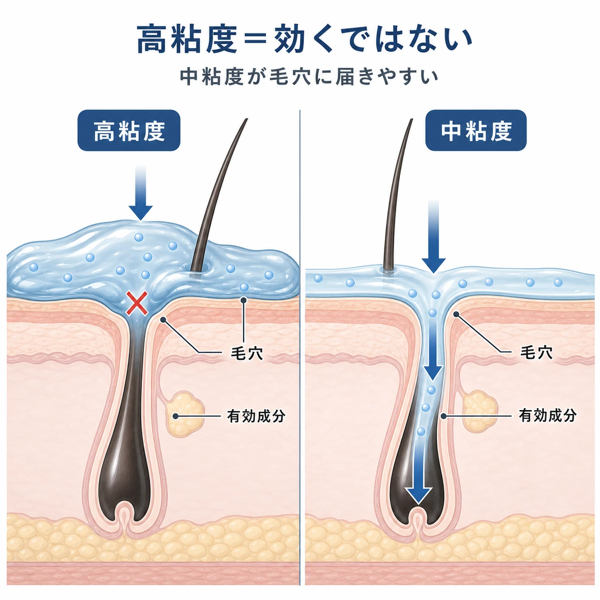 高粘度は毛穴にフタをし中粘度は毛穴へ浸透するという育毛成分の届き方の違いを表した医療イラスト