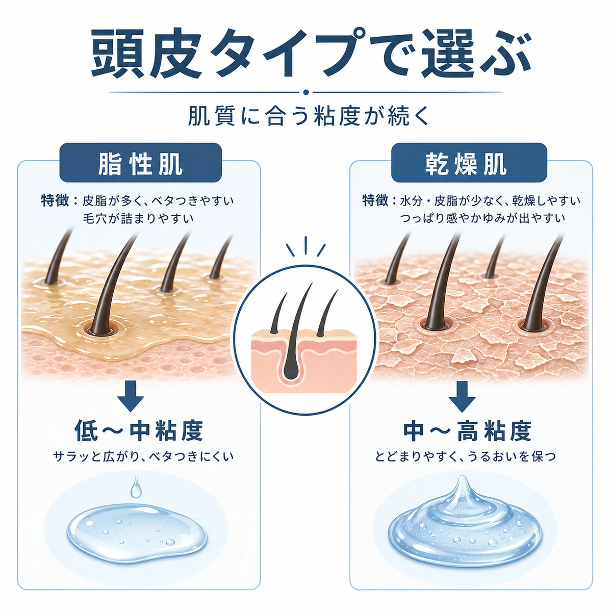 脂性肌は低め乾燥肌は高めなど頭皮タイプに合う育毛剤の粘度の選び方を表した医療イラスト