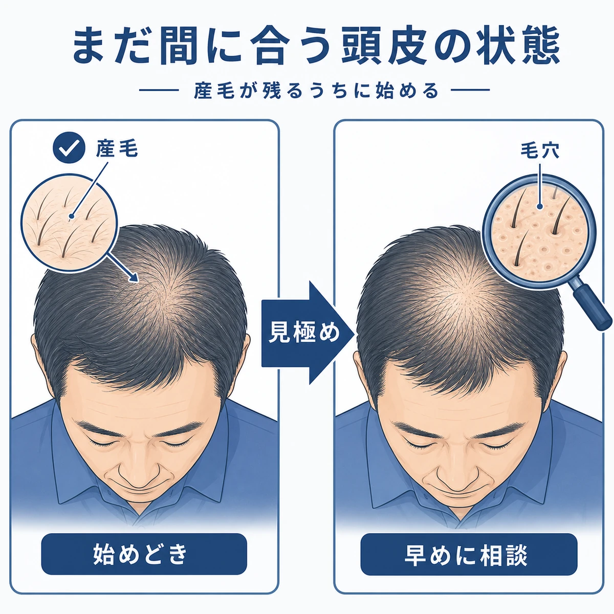 50代男性の頭皮の状態から育毛剤の効果が出やすい段階を見分ける様子を表した医療イラスト