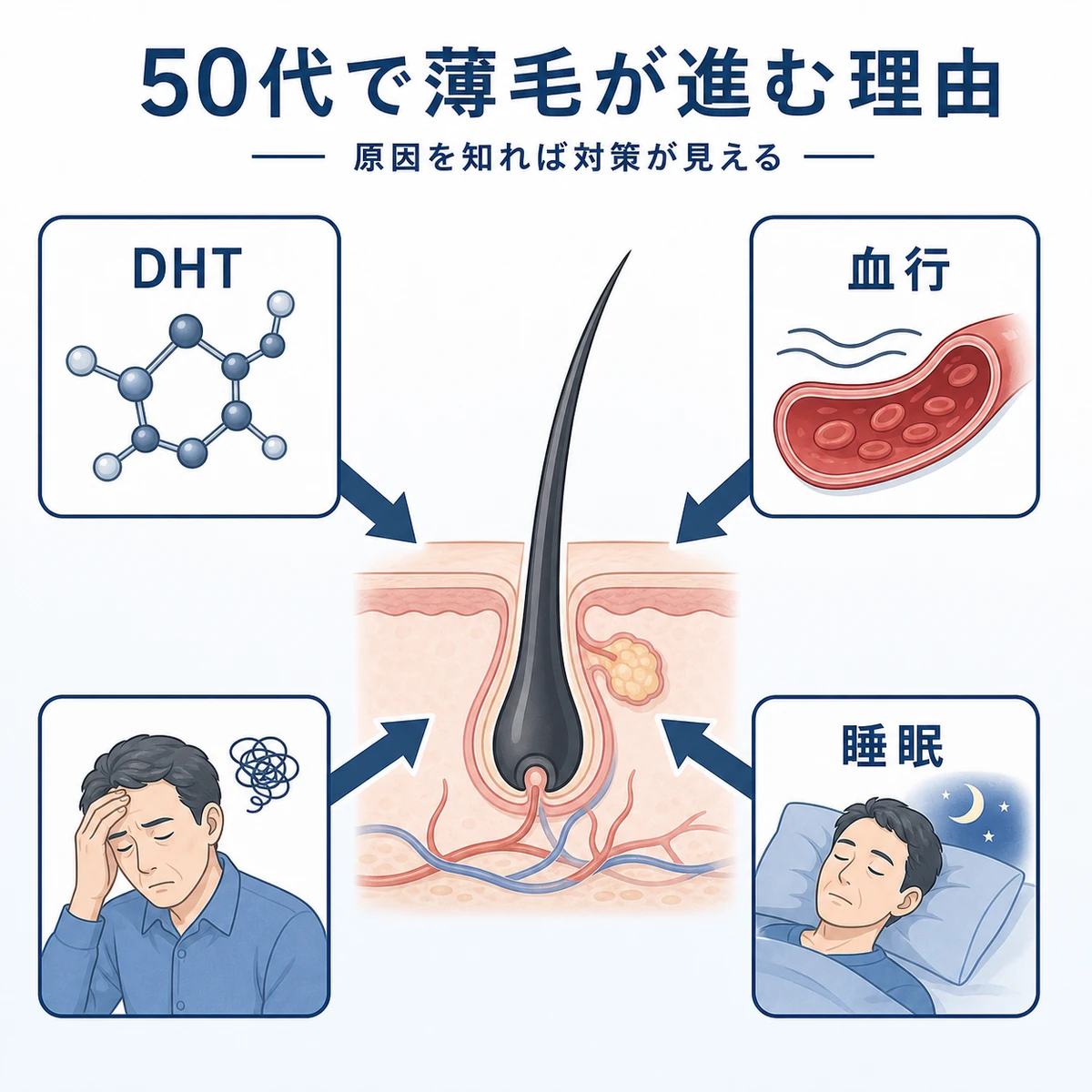 50代男性の毛根に複数の要因が重なって薄毛が進むしくみを表した医療イラスト