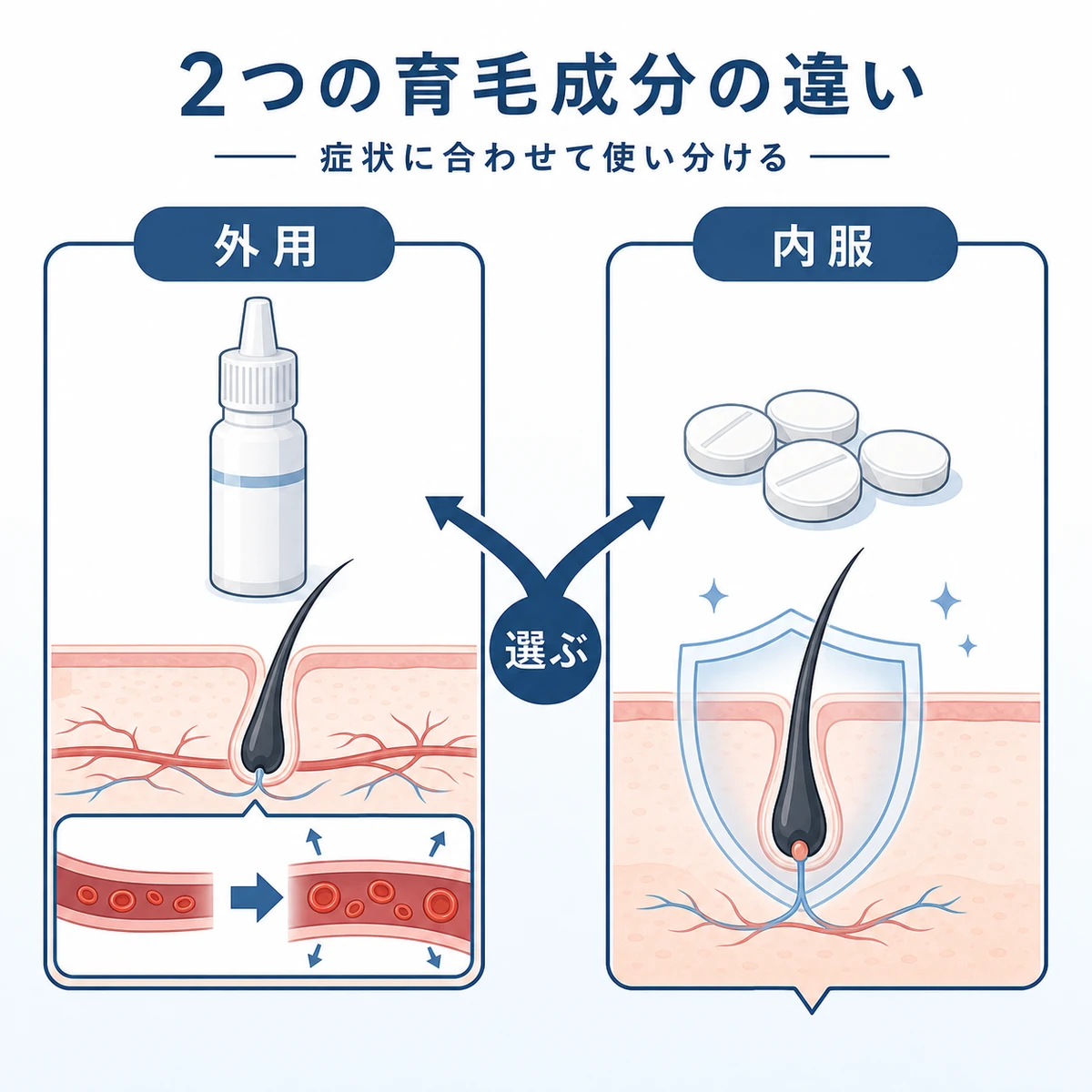塗り薬のミノキシジルと飲み薬のフィナステリドの作用の違いを対比した医療イラスト