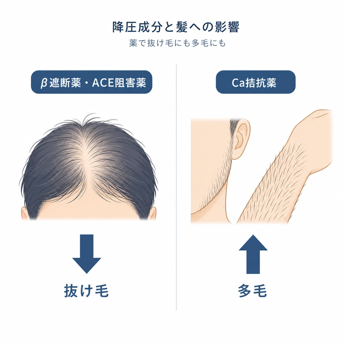 降圧剤の種類によって脱毛と多毛の逆方向の影響が出ることを対比した医療イラスト