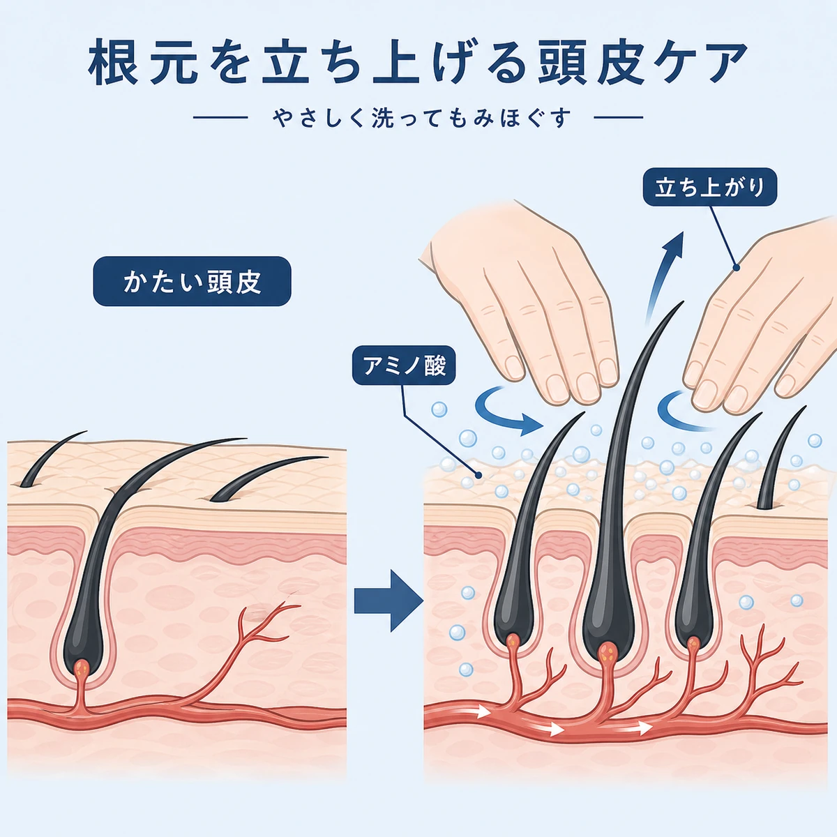 アミノ酸系の洗浄とマッサージで頭皮がほぐれ根元が立ち上がる様子を表した医療イラスト