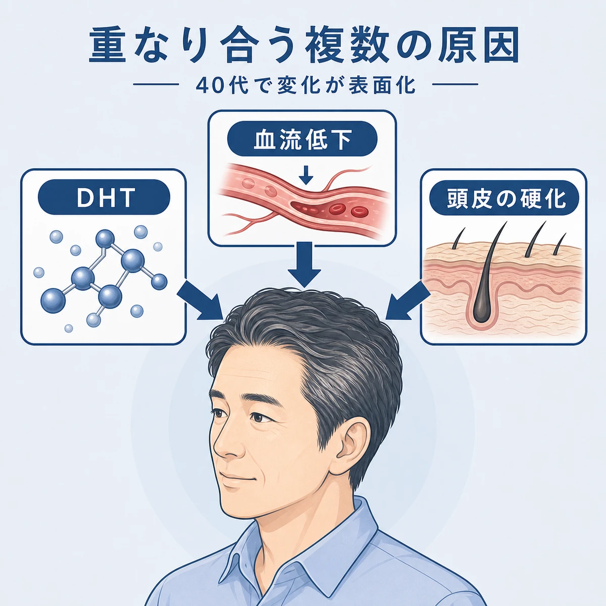 40代男性の薄毛を引き起こす複数の原因が重なり合う仕組みを表した医療イラスト