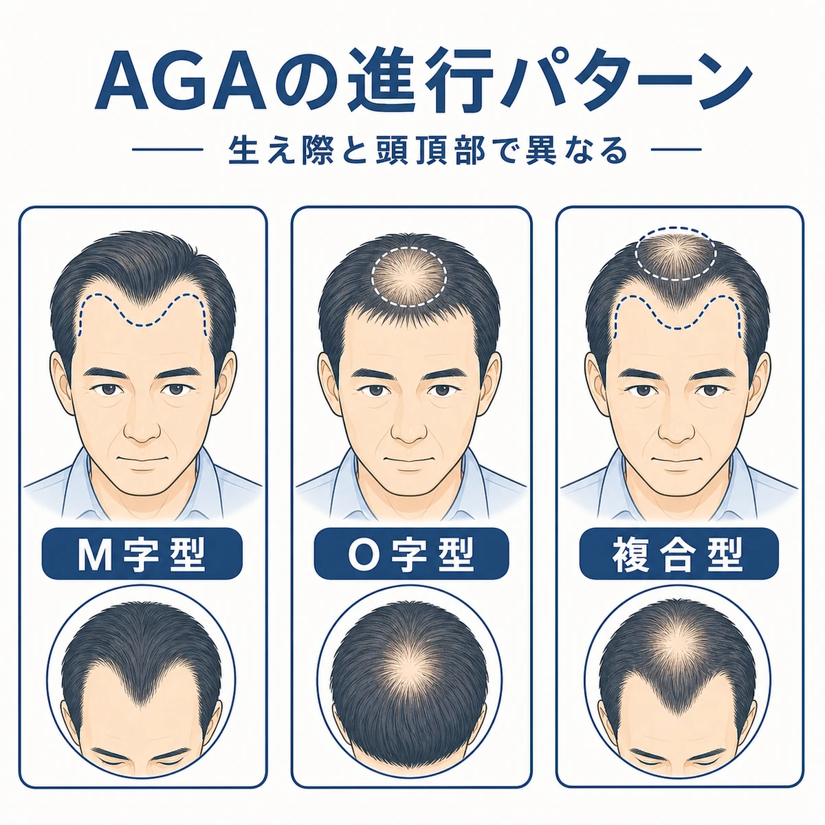 AGAのM字型・O字型・複合型という進行パターンの違いを比較した医療イラスト