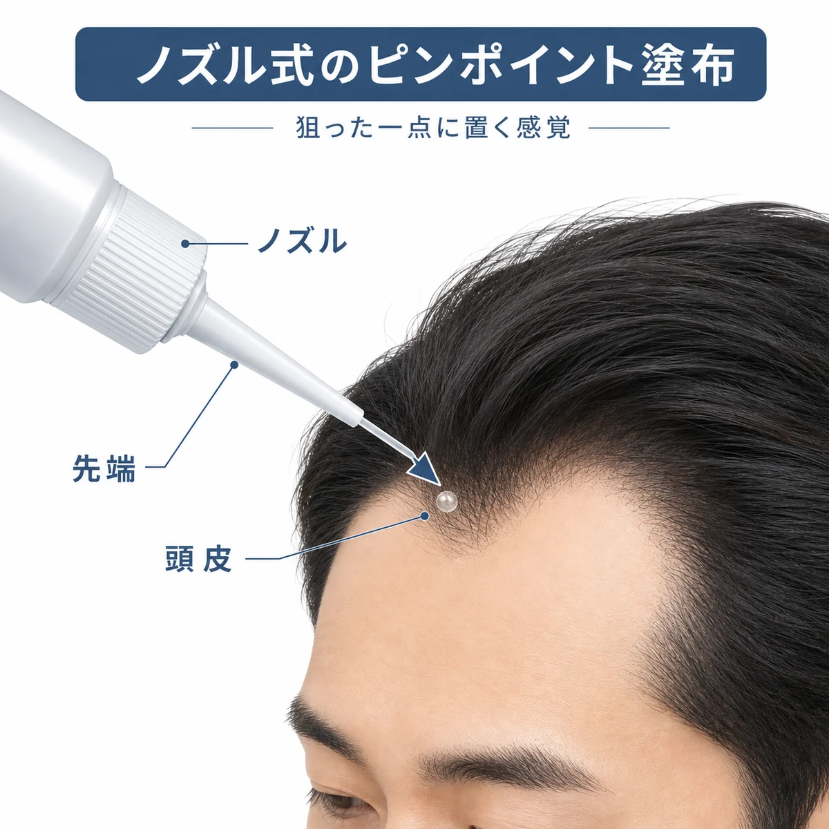 ノズル式容器の細い先端で成人男性の頭皮に薬液を一点だけ置く様子を表した医療イラスト