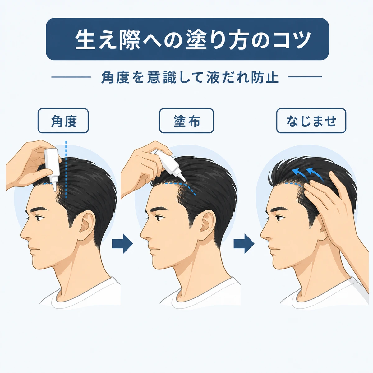 生え際に育毛剤を塗る手順を成人男性の横顔で段階的に表した医療イラスト