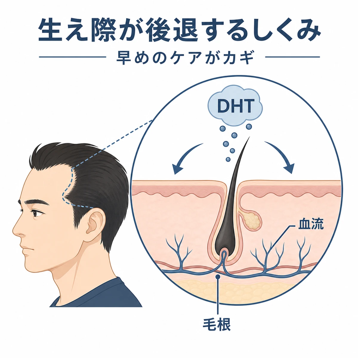 生え際の後退に関わるDHTと血流のしくみを断面図で表した医療イラスト
