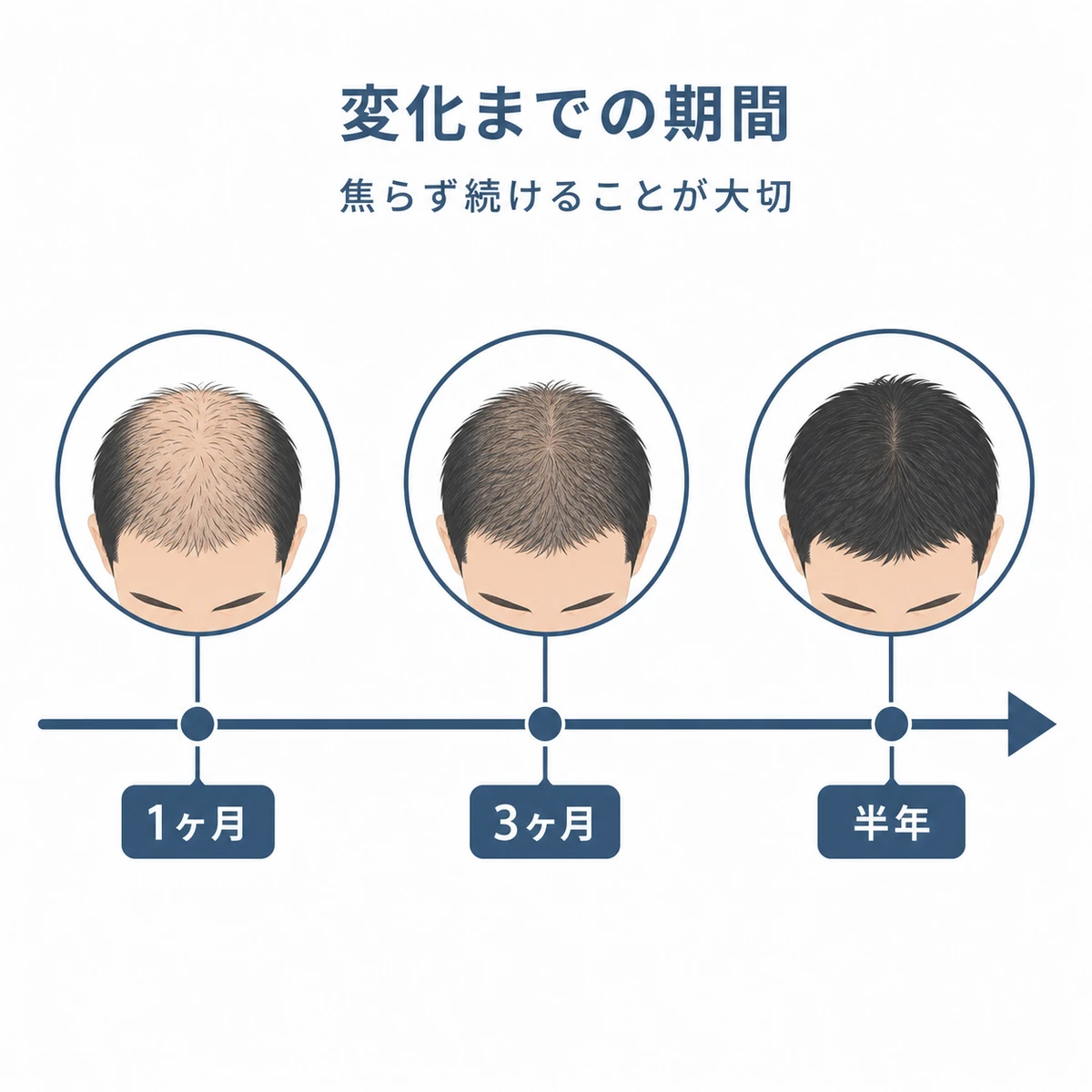 育毛剤の継続で生え際が少しずつ変化していく期間の目安を時間軸で表した医療イラスト
