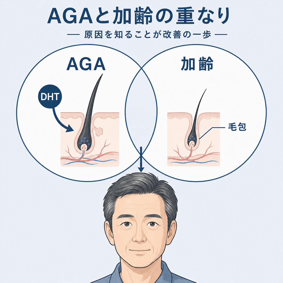 AGAと加齢が重なって50代男性の薄毛が進む仕組みを表した医療イラスト