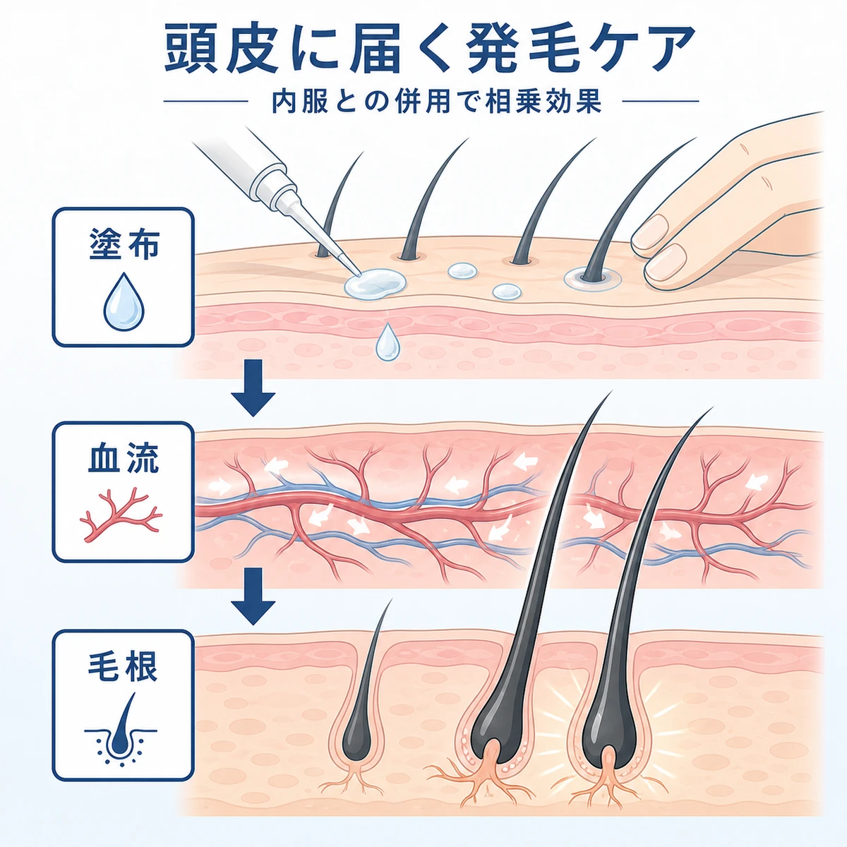 ミノキシジル外用薬が頭皮の血流を促して発毛を助ける仕組みを表した医療イラスト