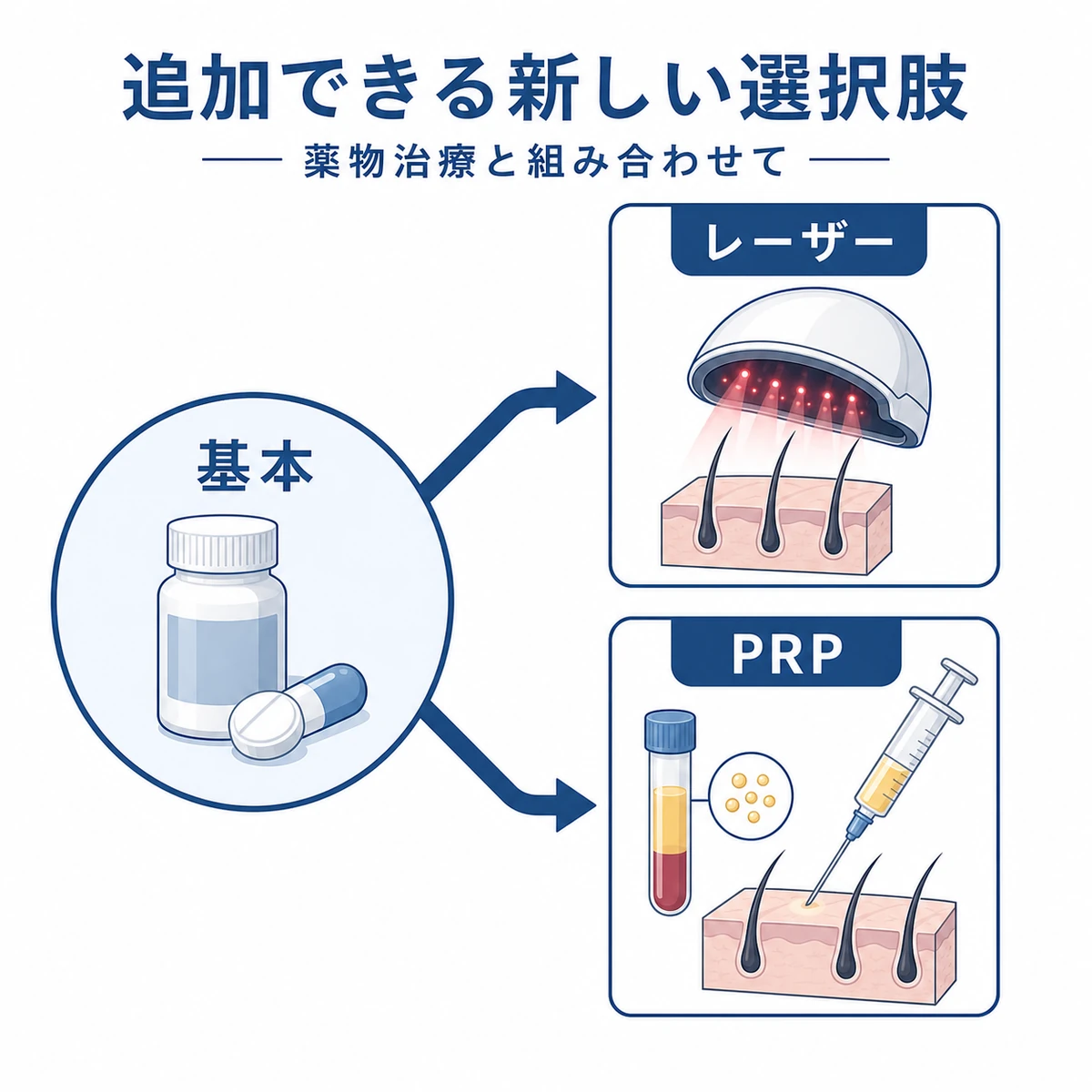 基本治療に追加するレーザー治療とPRP療法という新しい薄毛対策の選択肢を表した医療イラスト