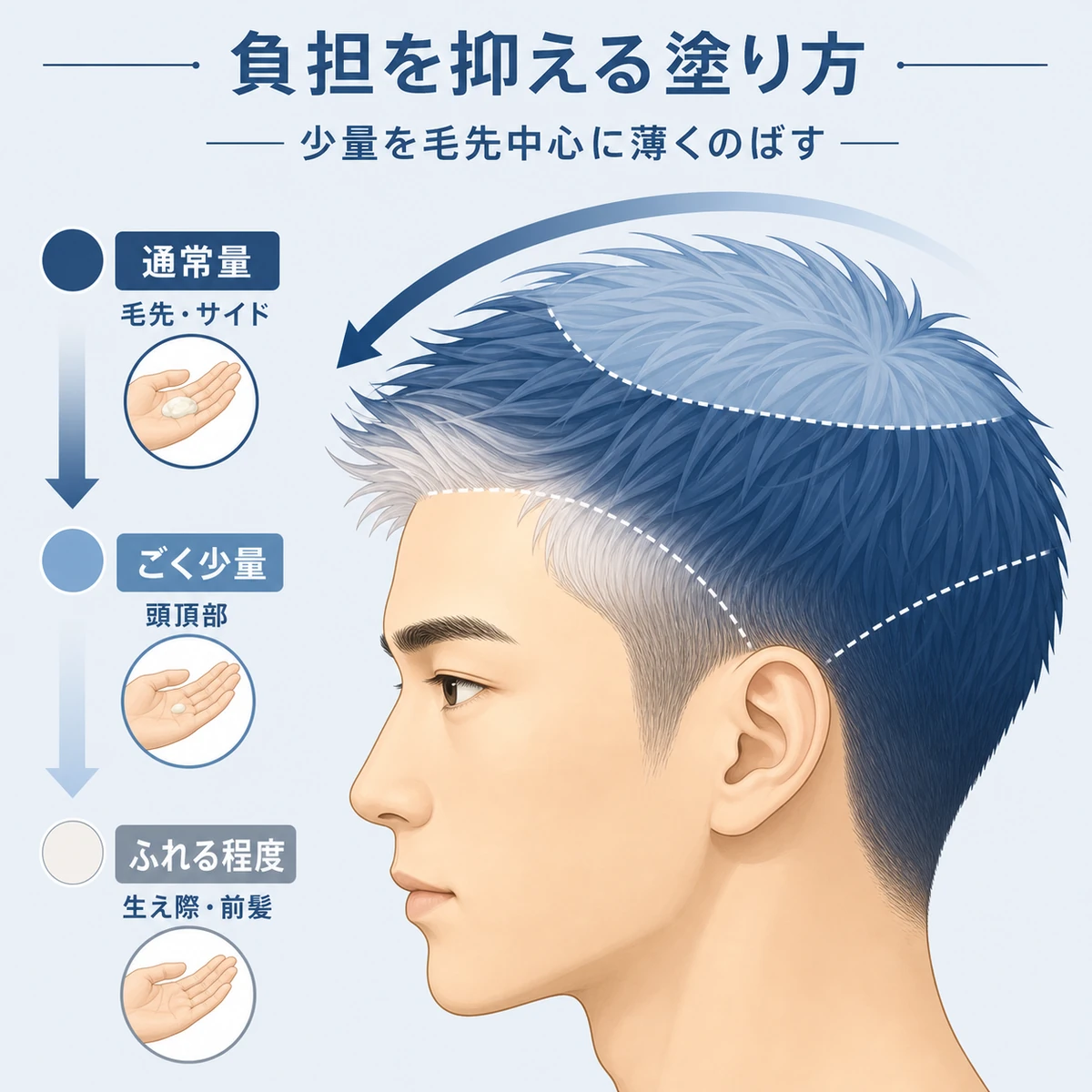 毛先は通常量で頭頂部や生え際はごく少量にする部位別の塗り方を表した医療イラスト