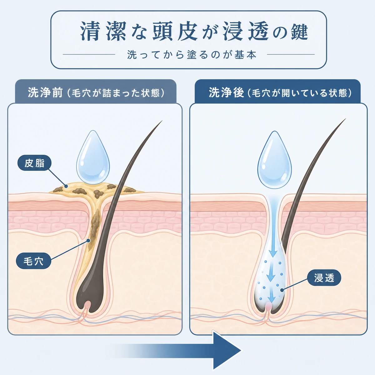 皮脂で詰まった毛穴と清潔な毛穴で育毛剤の浸透が変わる様子を対比した頭皮断面の医療イラスト