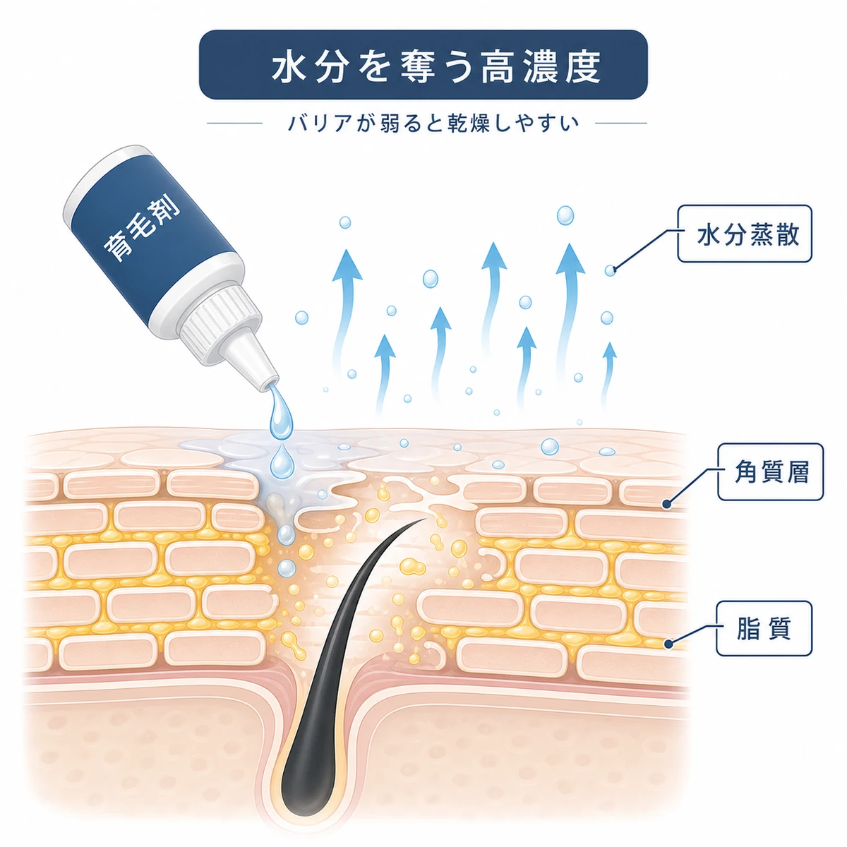高濃度アルコールで角質層の脂質が溶け水分が蒸散する頭皮乾燥のしくみを表した医療イラスト