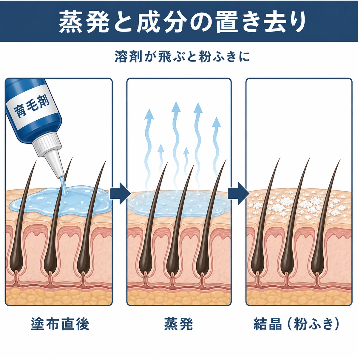 育毛剤のアルコールが蒸発した後に有効成分が結晶化して頭皮に残る流れを表した医療イラスト