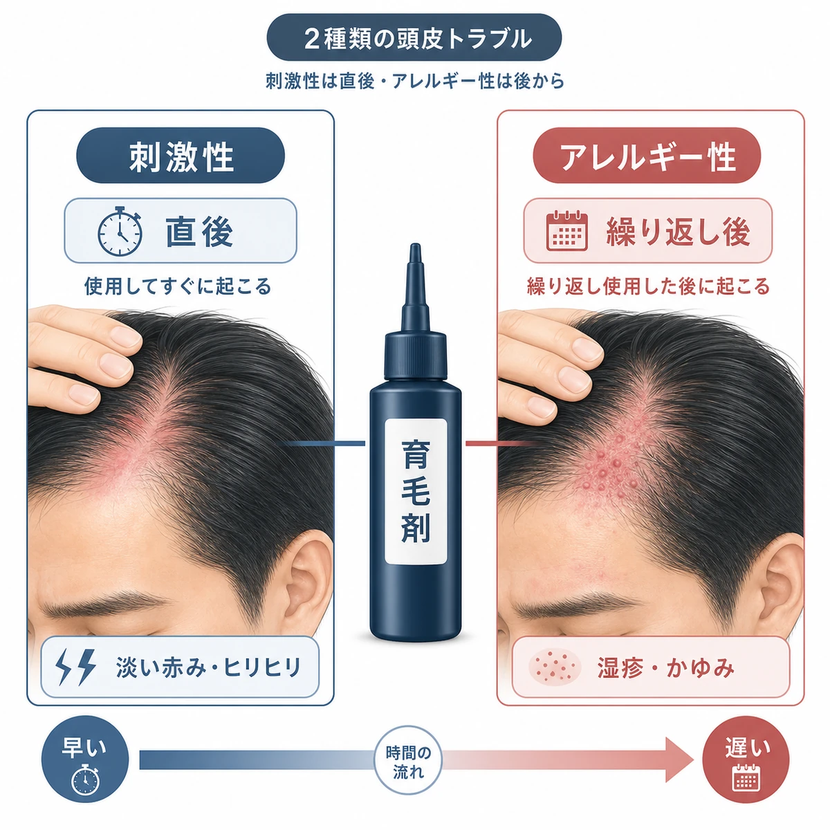 育毛剤による刺激性とアレルギー性の頭皮トラブルの違いを対比した医療イラスト