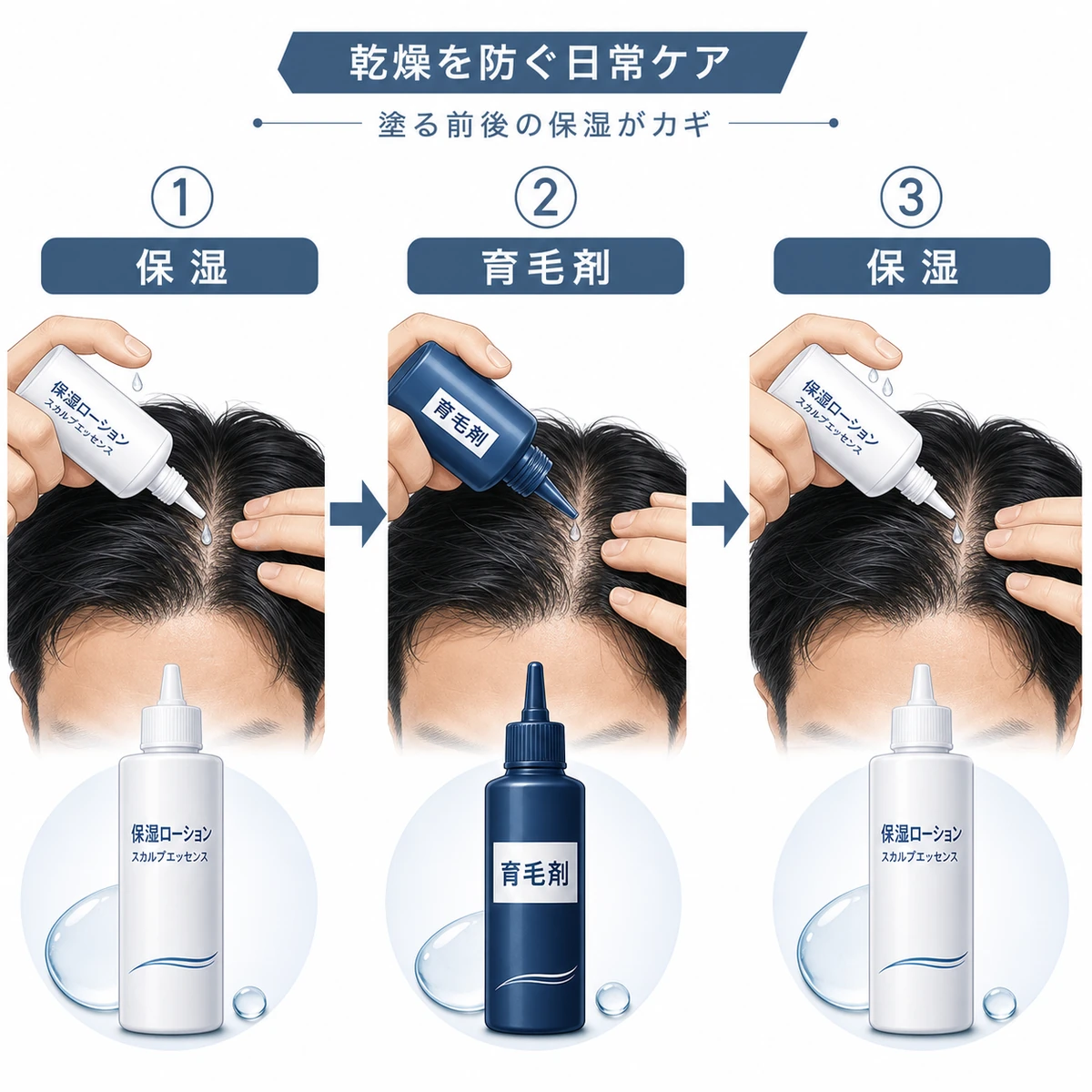 育毛剤を塗る前後に保湿ケアを重ねて頭皮の乾燥を防ぐ手順を表した医療イラスト