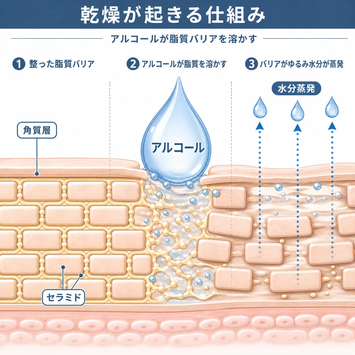 アルコールが頭皮の角質層の脂質バリアを溶かして水分が蒸発する仕組みを表した医療イラスト