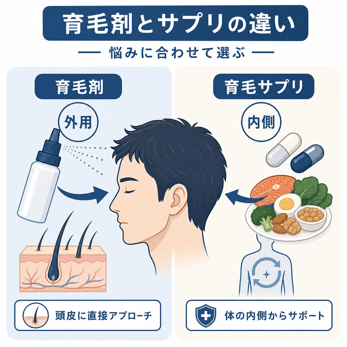 頭皮に塗る育毛剤と体の内側から補う育毛サプリの違いを左右で対比した医療系の解説イラスト