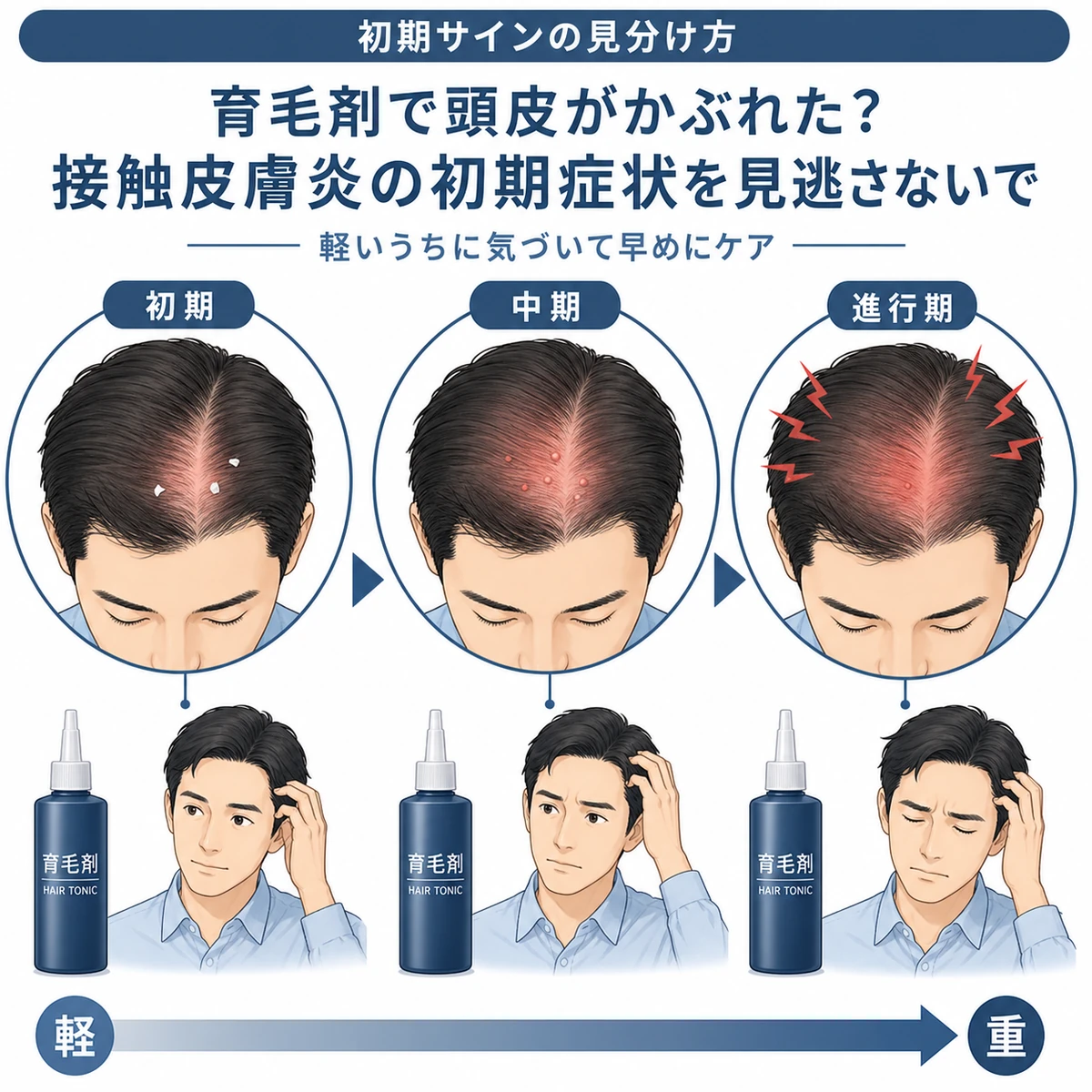 育毛剤による接触皮膚炎が初期から進行期へ進む3段階の流れを表した医療イラスト