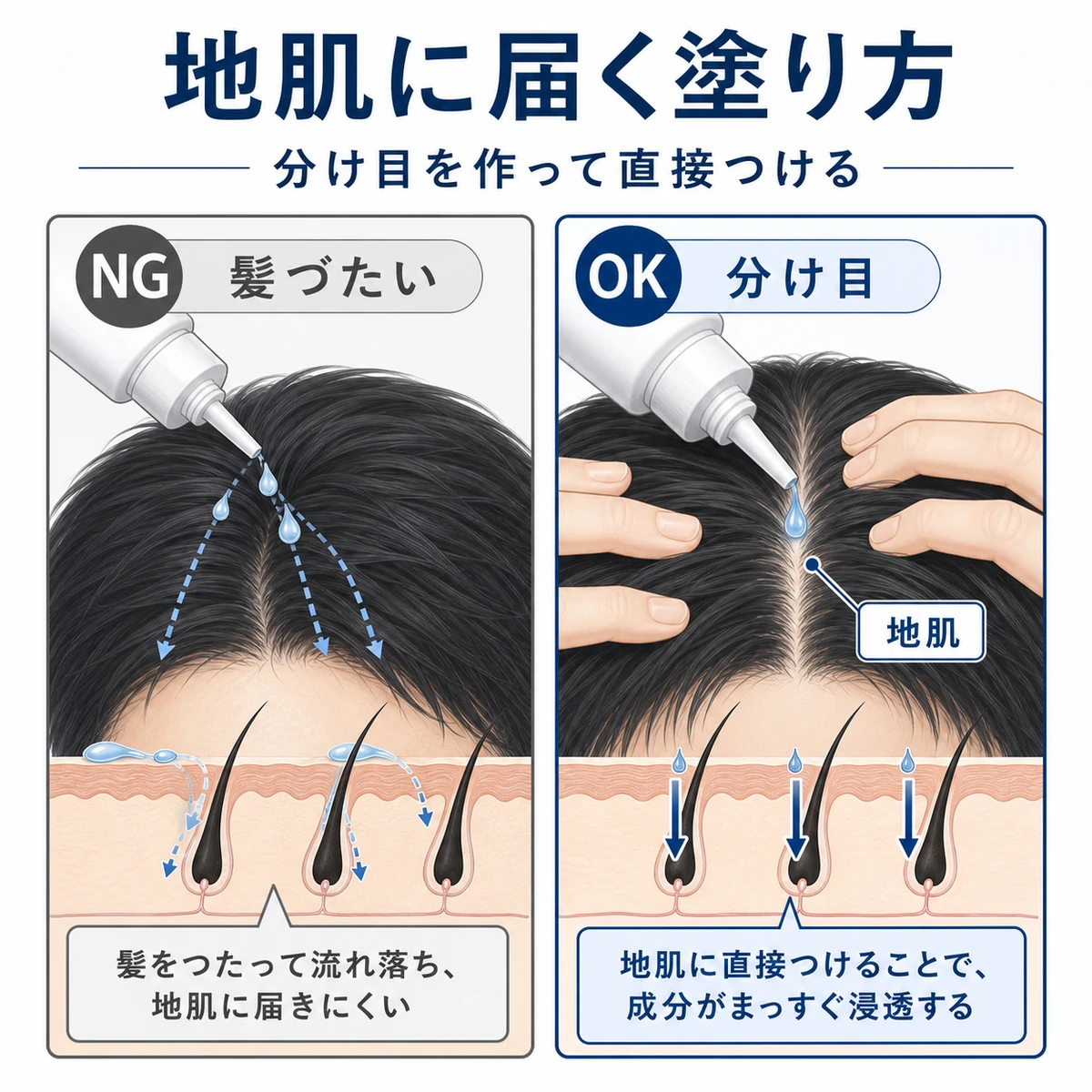 髪づたいでなく分け目を作り地肌へ直接塗ることで浸透率が上がる正しい育毛剤の塗り方を表した医療イラスト