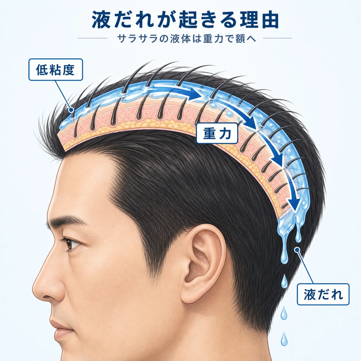 液体育毛剤が男性の額へ重力で流れ落ちる仕組みを表した医療イラスト