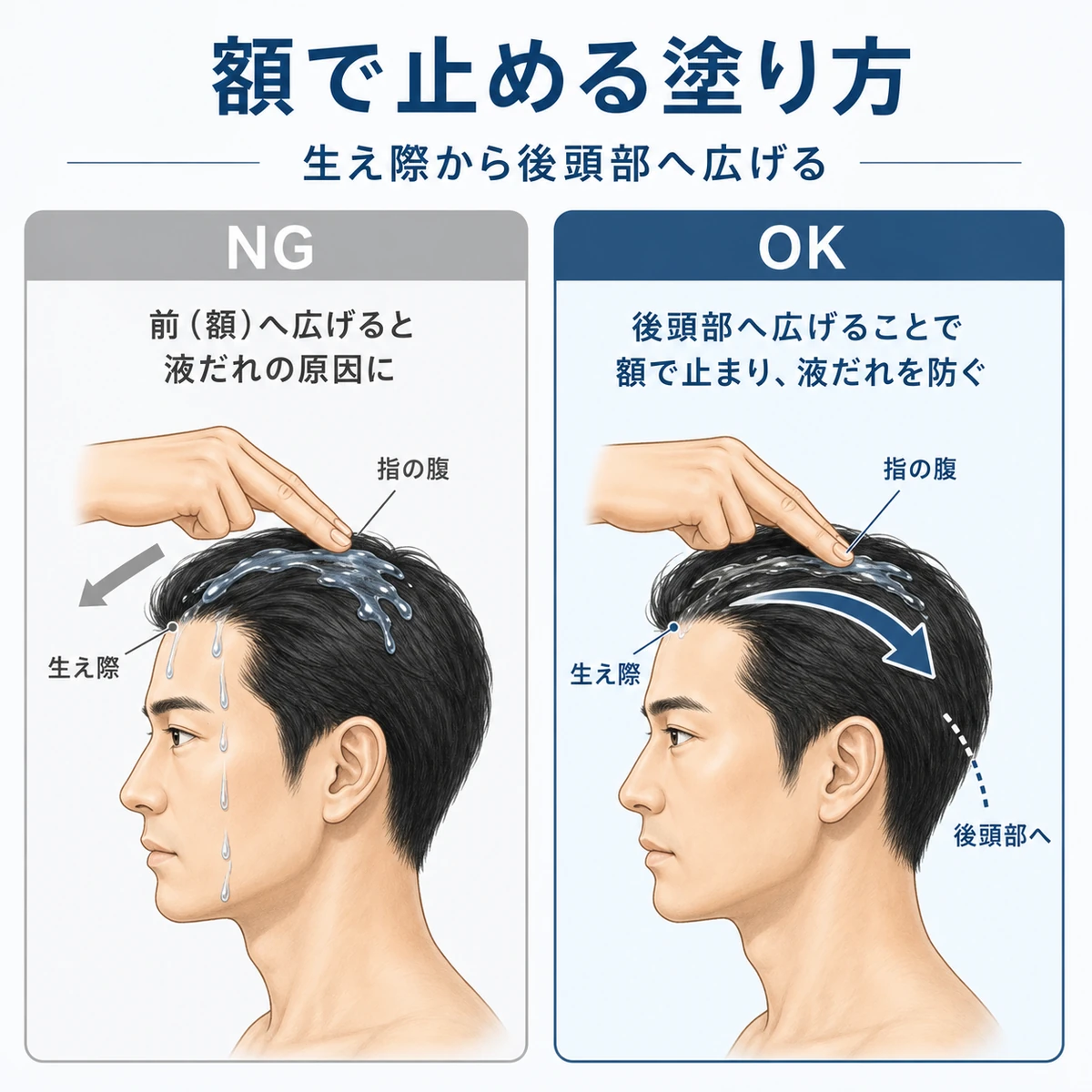 生え際から後頭部へ向けて塗り広げ額への垂れを防ぐテクニックを表した医療イラスト