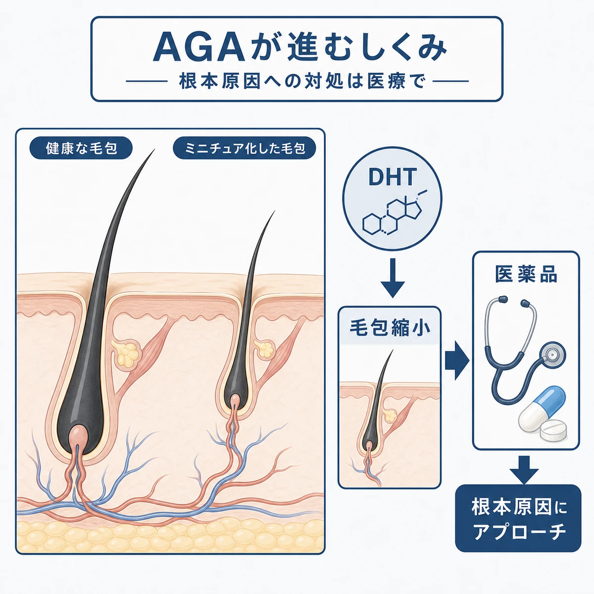 DHTの影響で毛包が縮小するAGAのしくみと医薬品の役割を示した医療イラスト