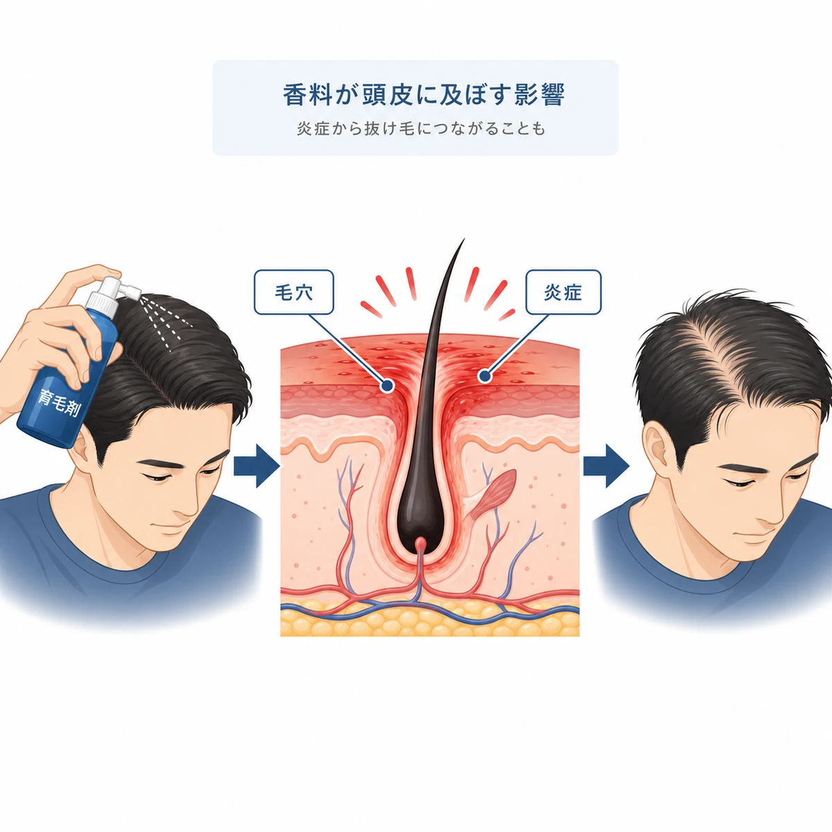 育毛剤の香料による頭皮の炎症が抜け毛につながる流れを表した医療イラスト