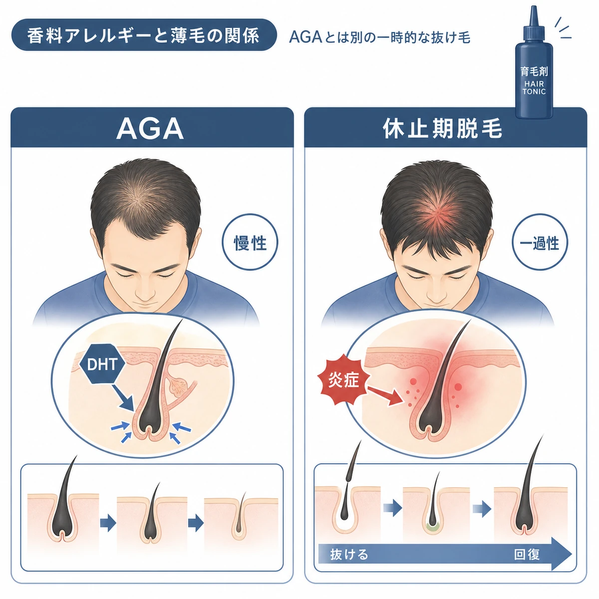 AGAと休止期脱毛の違いから香料アレルギーと薄毛の関係を表した医療イラスト