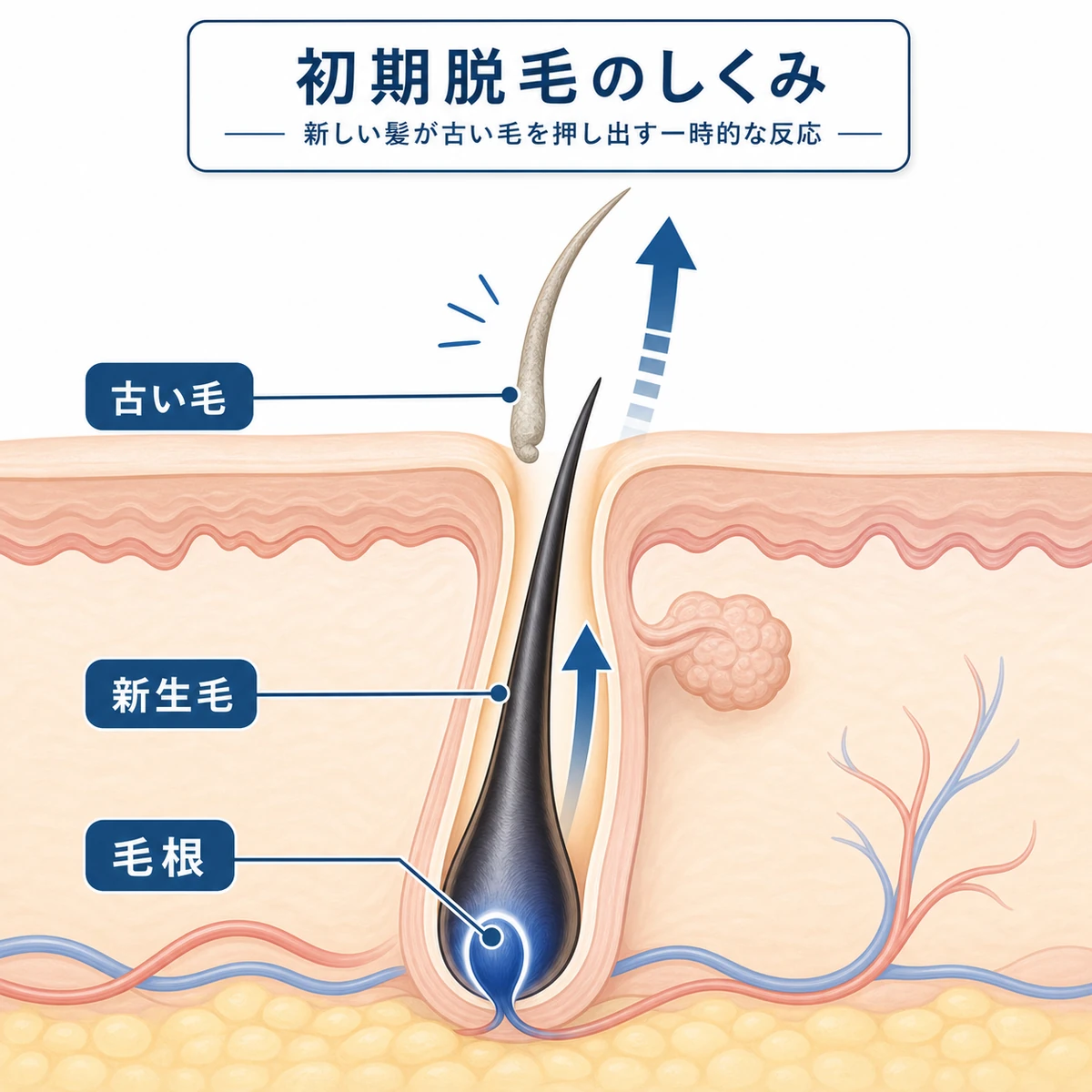 毛穴の奥で新しい髪が古い毛を下から押し上げて抜ける初期脱毛のしくみを表した医療イラスト
