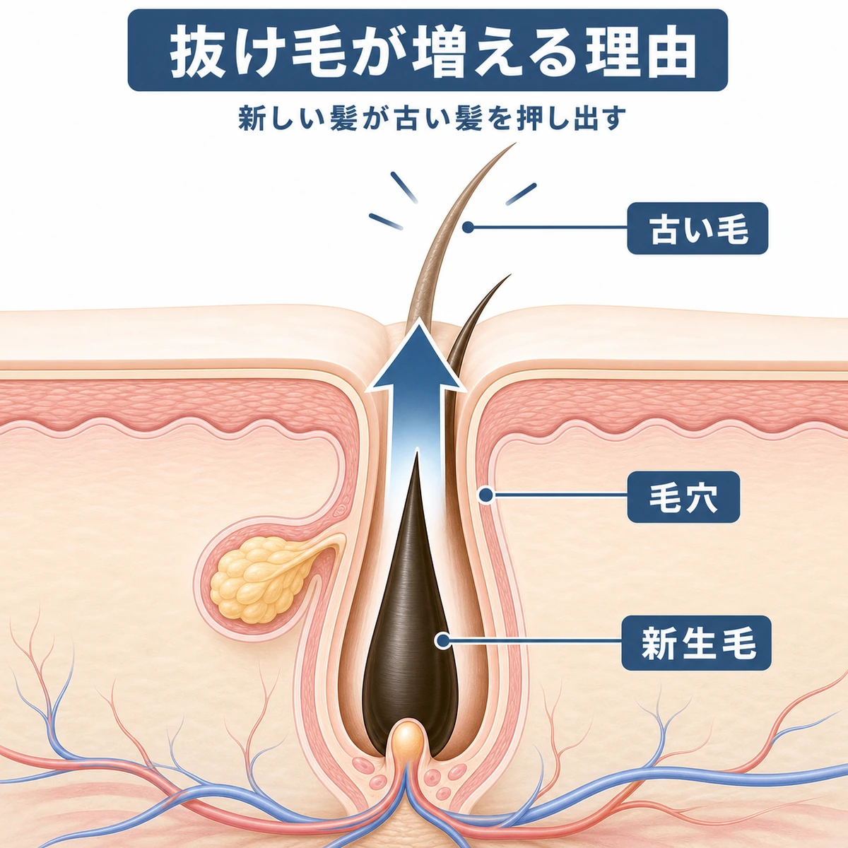 毛穴の中で新生毛が古い毛を下から上へ押し出す初期脱毛のしくみを表した医療イラスト