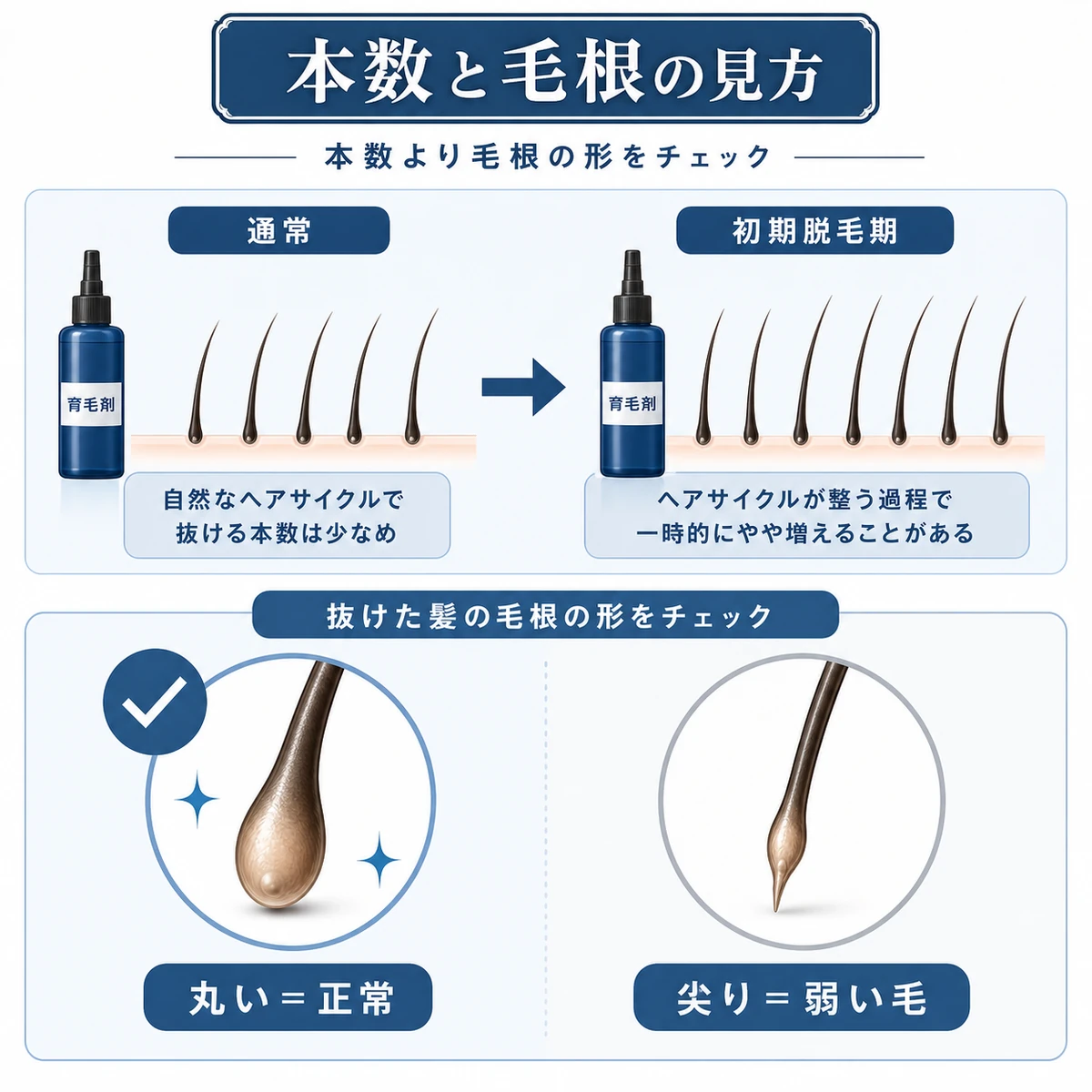 抜け毛の本数の目安と毛根の形の違いを対比して示した医療イラスト