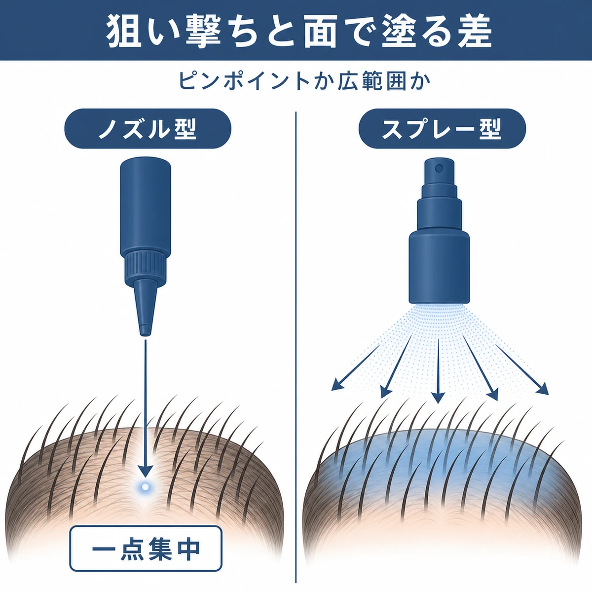 ノズル型の一点集中とスプレー型の広範囲噴射の違いを対比した育毛剤の解説イラスト
