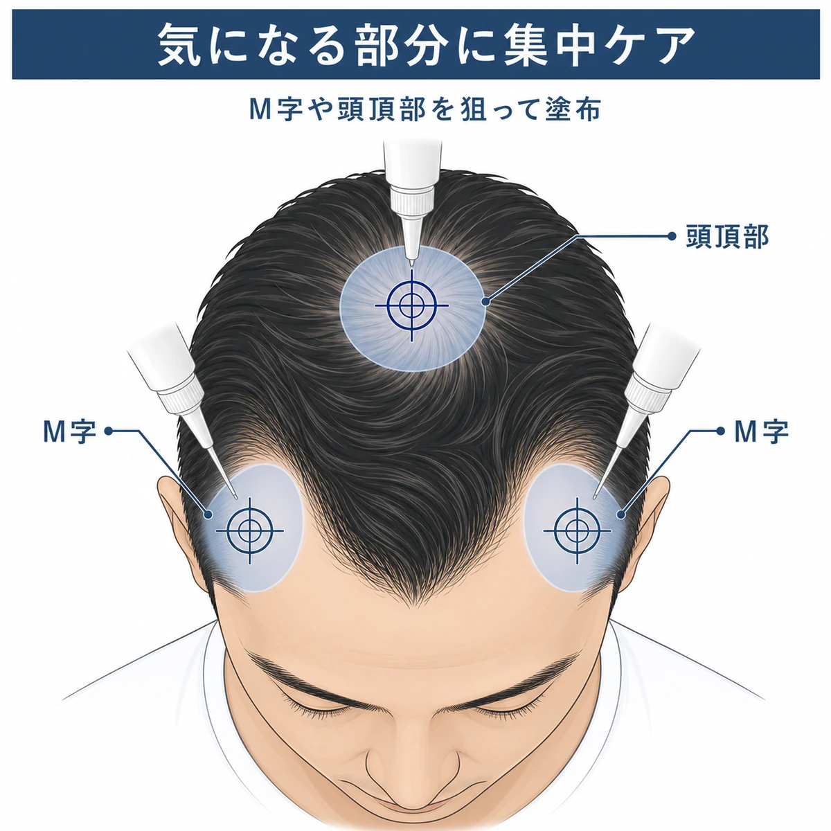 M字と頭頂部の局所的な薄毛にノズル型でピンポイント塗布する位置を示した育毛剤の解説イラスト