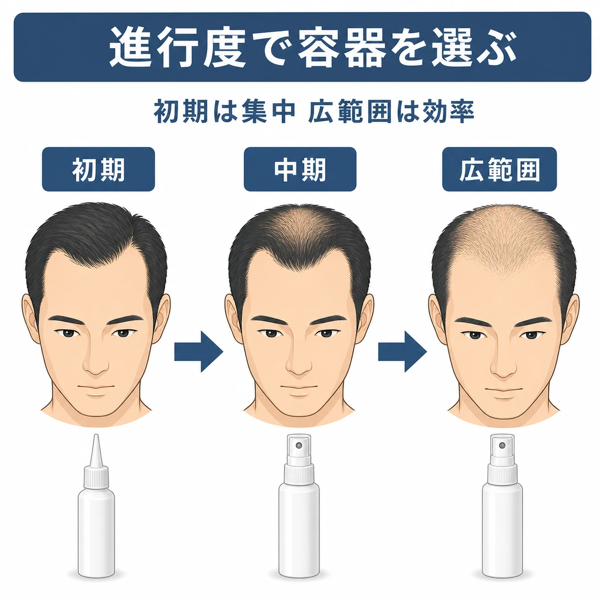 初期から広範囲への薄毛の進行度に応じてノズル型とスプレー型を使い分ける段階を表した育毛剤の解説イラスト