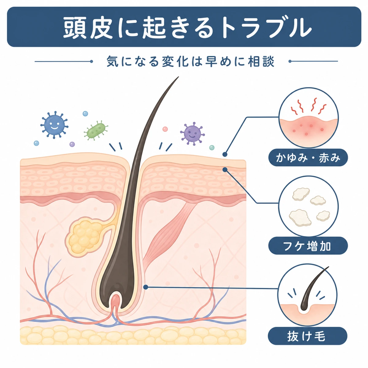 雑菌入り育毛剤で頭皮の毛穴に起きるトラブルを表した医療イラスト