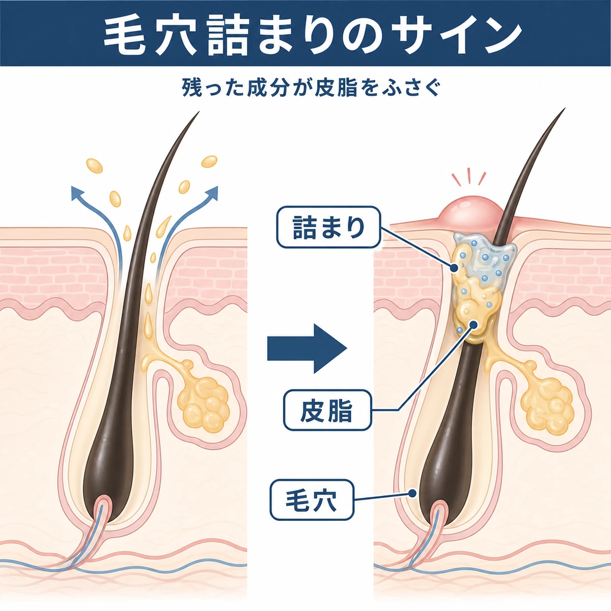 正常な毛穴と詰まった毛穴を並べ、育毛剤の成分が毛穴をふさいで頭皮ニキビにつながる仕組みを表した頭皮断面の医療イラスト