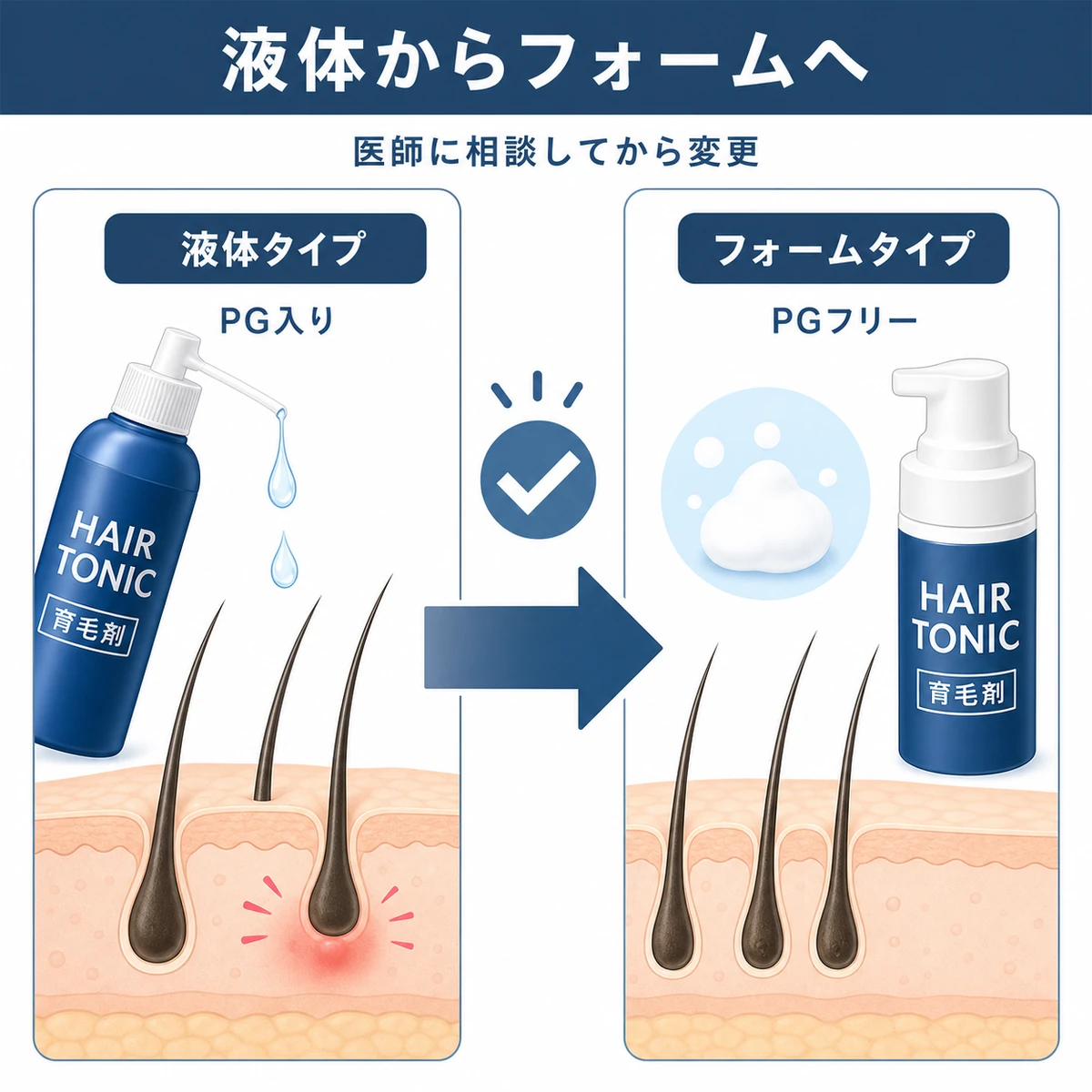PG入りの液体タイプからPGフリーのフォームタイプへ育毛剤を切り替えると刺激が減る流れを左右で対比した医療イラスト