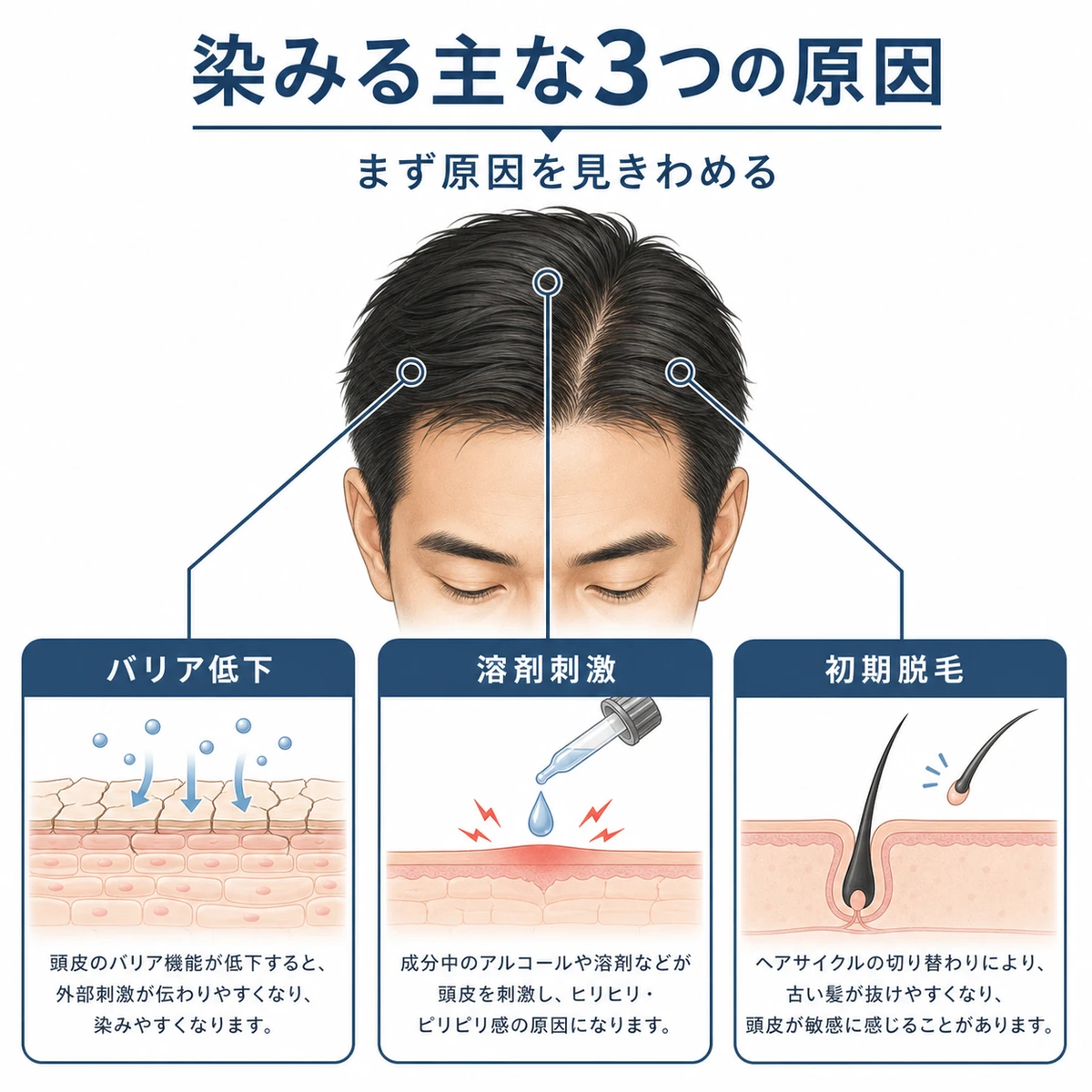 育毛剤で頭皮が染みる3つの原因を頭部から分類した医療イラスト