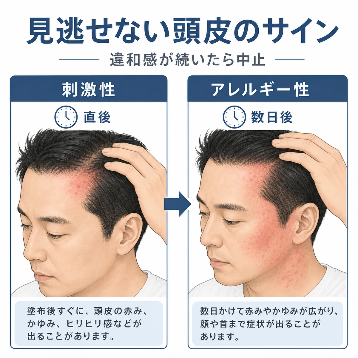 刺激性とアレルギー性の頭皮トラブルを発症時期で対比した医療イラスト
