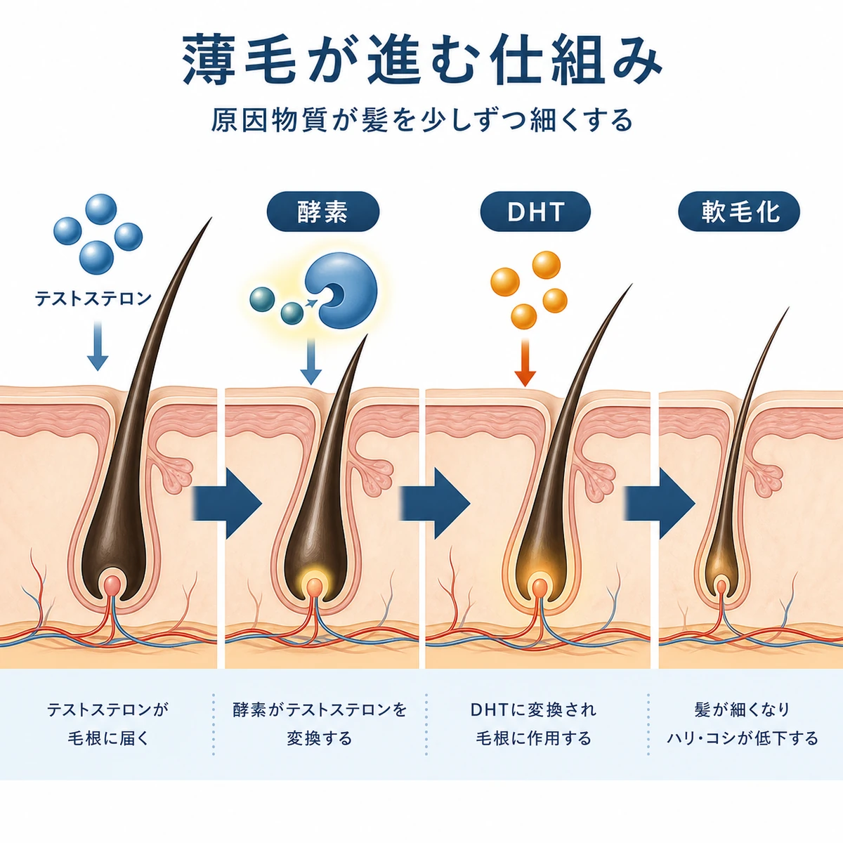 男性ホルモンが原因物質に変わり髪が細くなる流れを示した医療イラスト