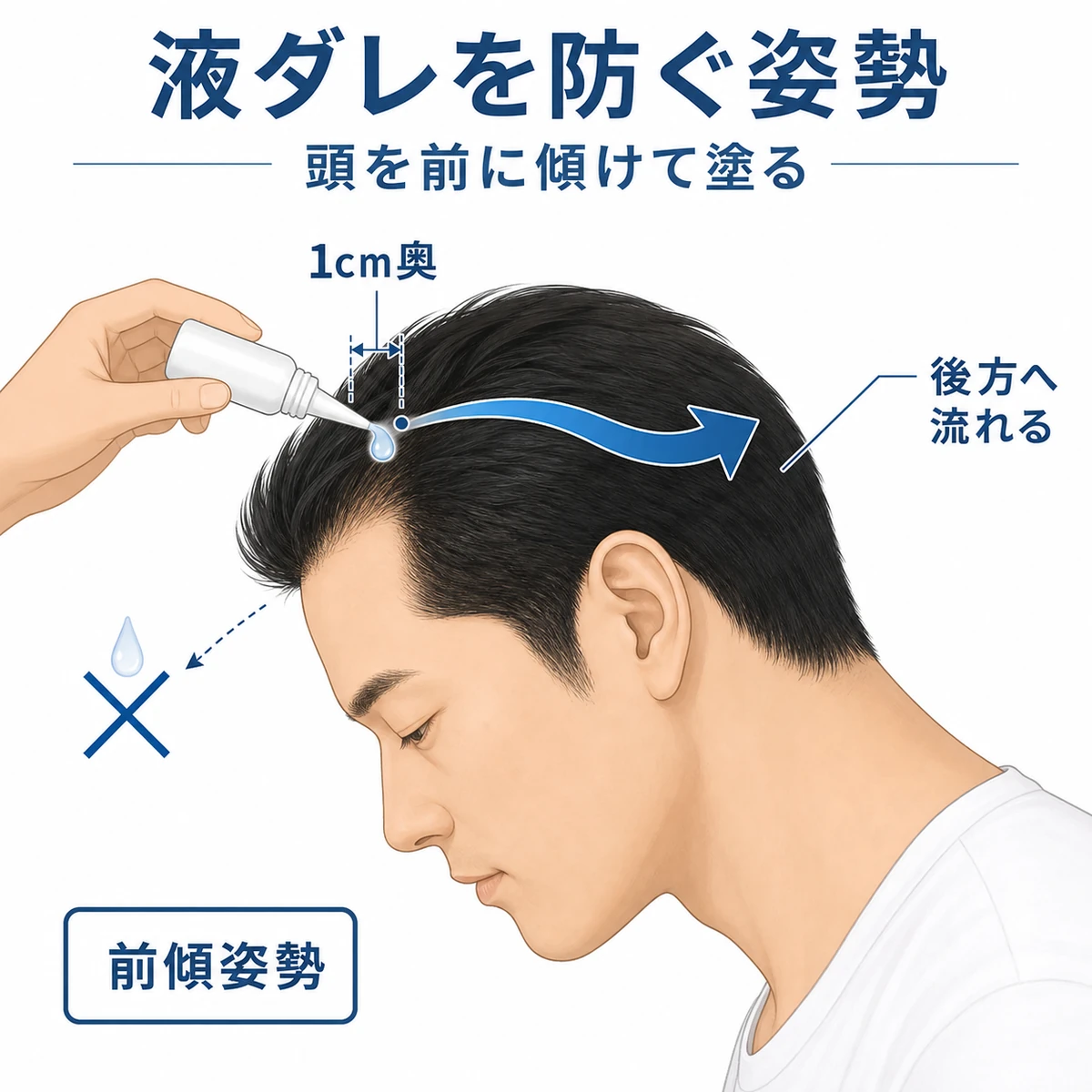 頭を前に傾けて育毛剤を塗ると液が目でなく後方へ流れる様子を表した医療イラスト
